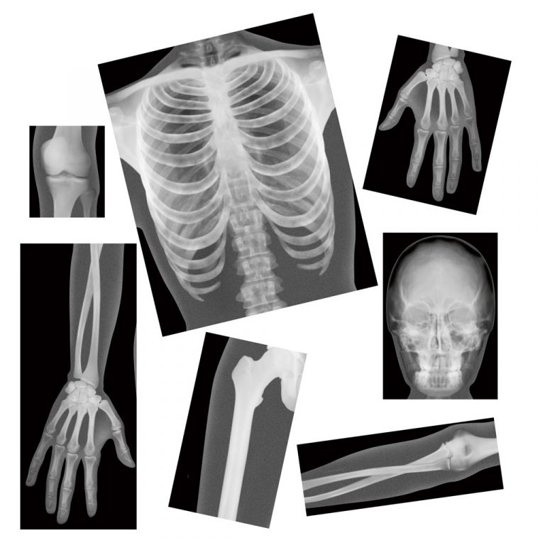 Radiographie – cim albizzias